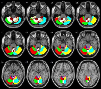 Cerebellum regulating cerebral functional cortex through multiple pathways in complete thoracolumbar spinal cord injury